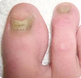 Bőrbetegségek a kezeken: az ujjakon, a kezeken, a tenyéren